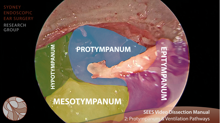 Video otology tutorials: how EES changes the game | ENT & Audiology News