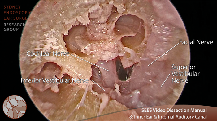 Video otology tutorials: how EES changes the game | ENT & Audiology News