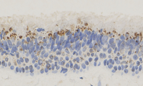 Staphylococcus aureus as a cause of refractory chronic rhinosinusitis