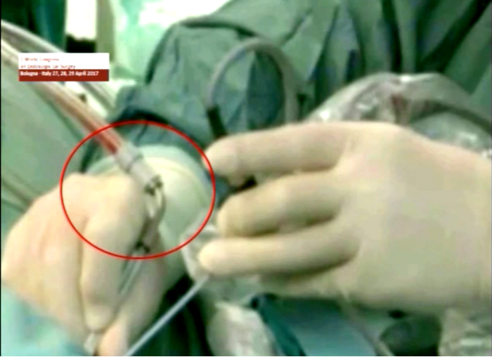 Endoscopic Ear Instruments ENT & Audiology News