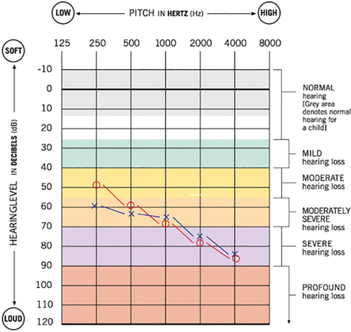 Cochlear implants for children ENT & Audiology News